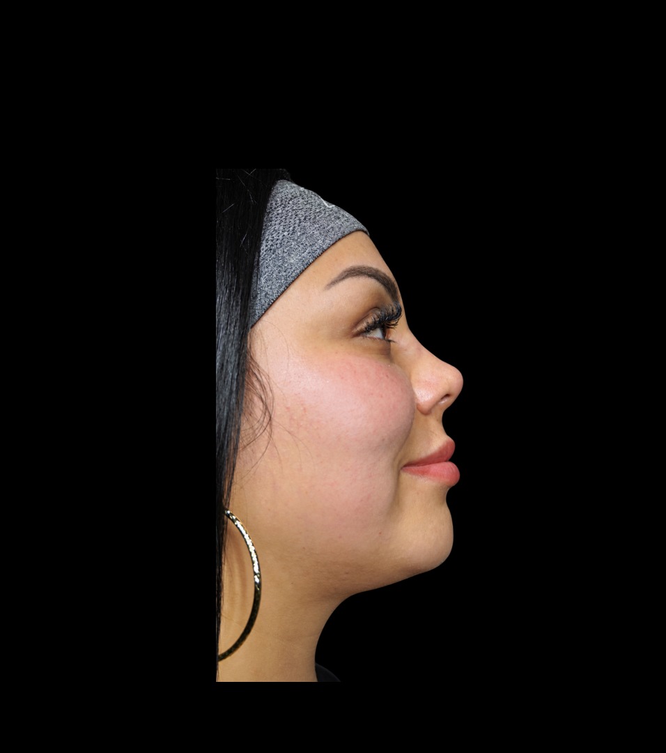 Proyección de nariz